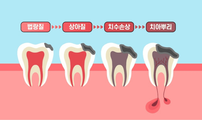 진행 단계별로 나뉘는 충치 치료 방법