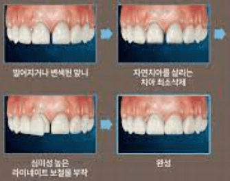 라미네이트 시술이 진행되는 단계