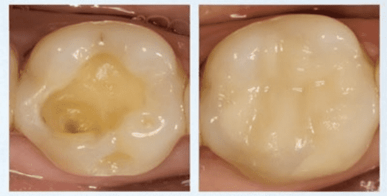 불소가 함유된 GI 충전재